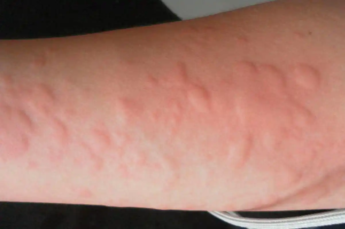 荨麻疹治疗历程!从红斑,瘙痒到症状缓解,这个方案可一试!