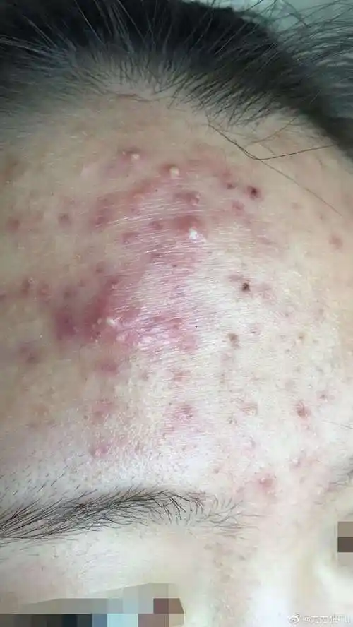 脓疱型痤疮