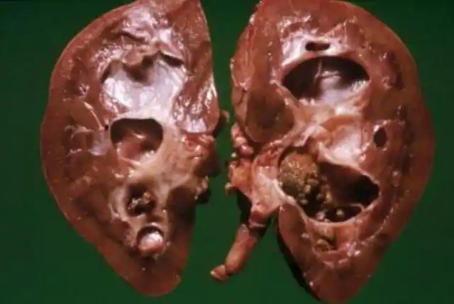 肾结石是养出来的这5个养石坏习惯你可能正在做