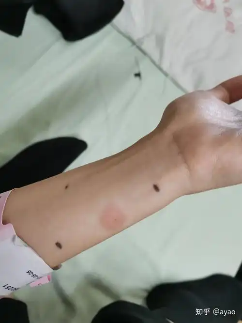 结核病皮试结果怎么看? - 知乎