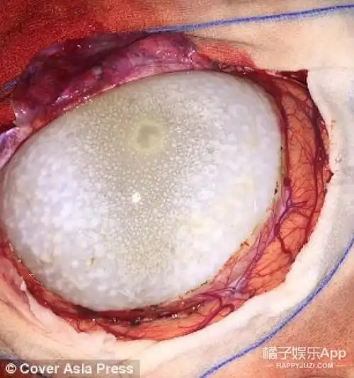 印度女童遭寄生虫入侵,脑部挖出史上最大囊肿