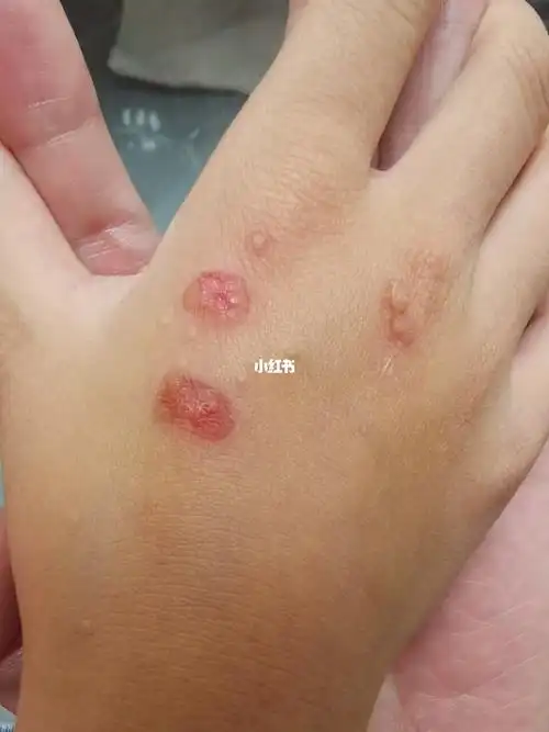 扁平疣治疗小记第11天