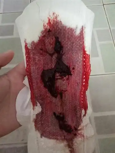 月经血块过多