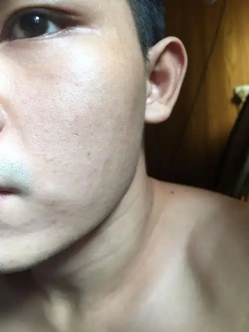 毛孔粗大,黑头多,油性皮肤,看起来很老化的感觉,有什么方法可以做到让