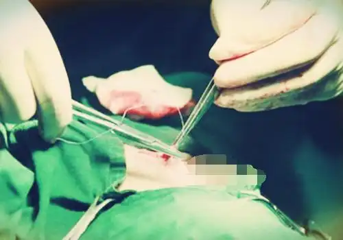 女性绝育术又叫输卵管结扎术,这种方式可阻止卵子由输卵管运输到子宫