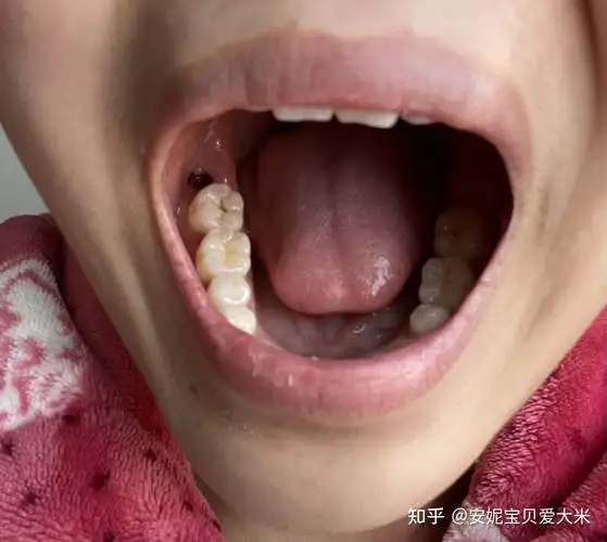 有一颗智齿一半长出来了一半在肉里,位置正,要拔吗? - 知乎