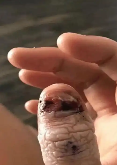 娃又把指甲啃秃了,没事就啃,怎么破?_孩子