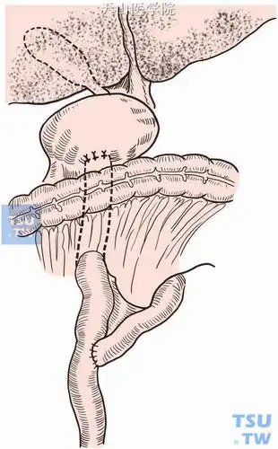 结肠后空肠囊肿roux-en-y吻合