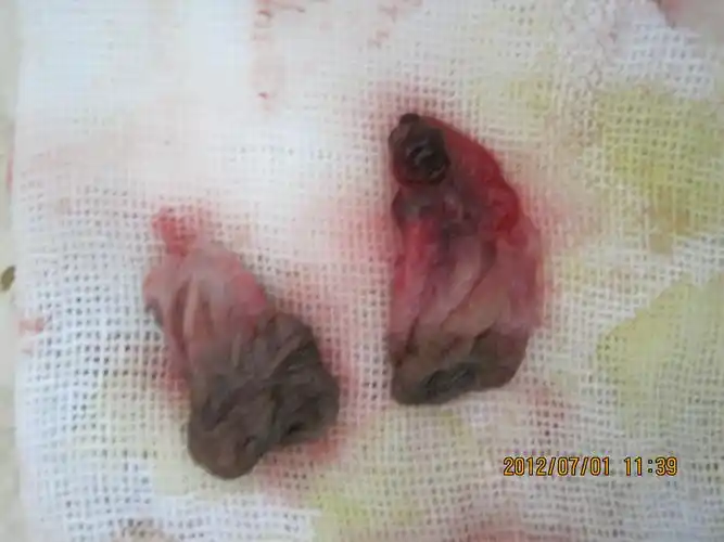 病人要上班做其中两个最大的混合痔术前术中术后图