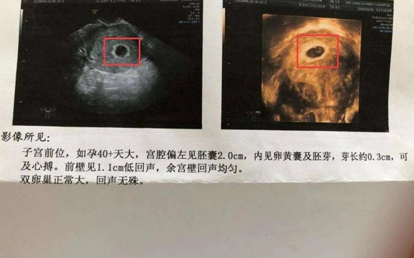 孕囊大小看男女对照表