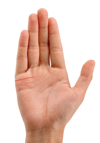 一旦肝损伤时在手掌就是出现