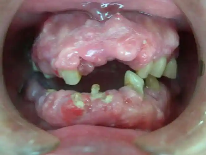 牙周炎治疗前后比较