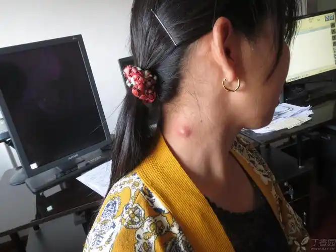 【共享】颈部表皮样囊肿 [病例帖]