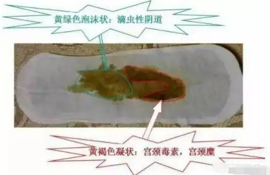 身体有什么问题雪莲贴就会排出什么毒素不会看贴的家人赶快了自我对照