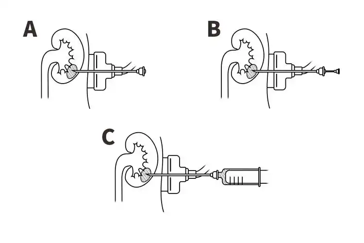 对于体积较大的肾囊肿常采用的手术方式包括穿刺引流加硬化剂注射术