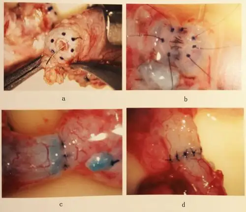 马逸医生典型案例:输精管结扎后如何复通? (原创)_手术