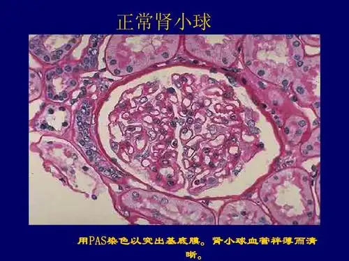 肾病综合征病理图片ppt