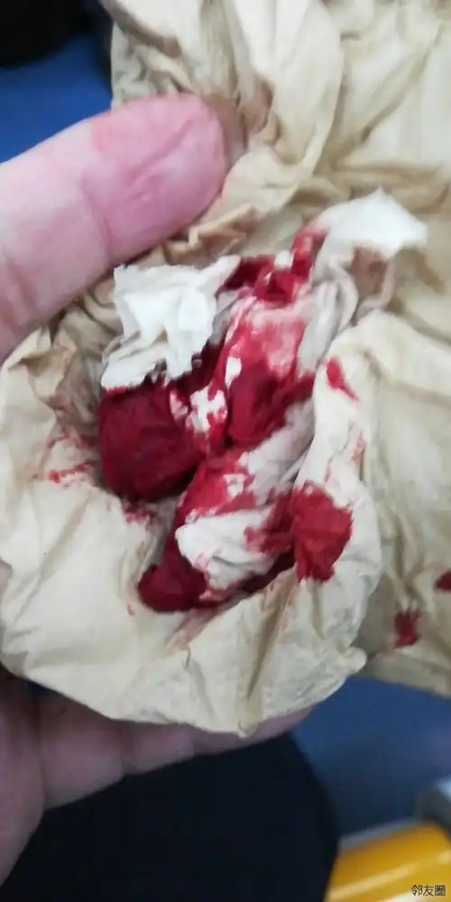 今天地铁里流鼻血把人都吓跑了