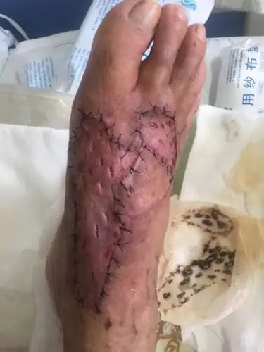 植皮术后一周,皮片成活良好