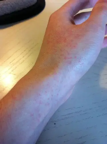 左手这一小块地方发了一些这种红疹子,有一丁点痒但发红!