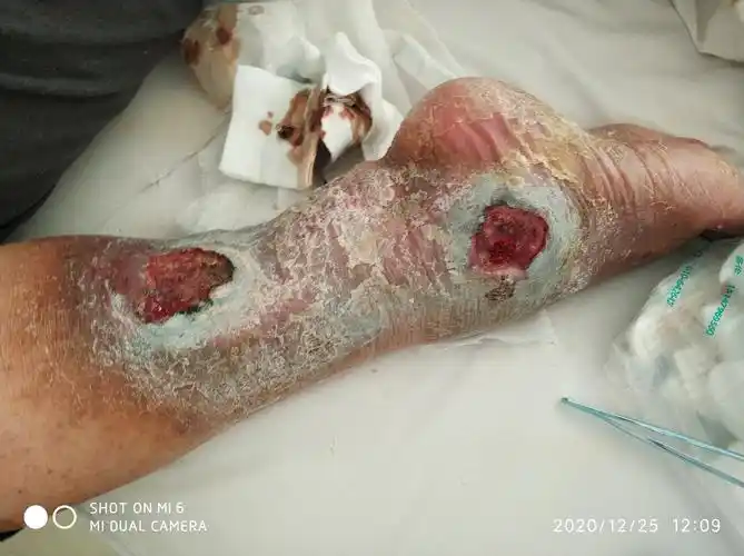 中药治疗下肢破溃一例