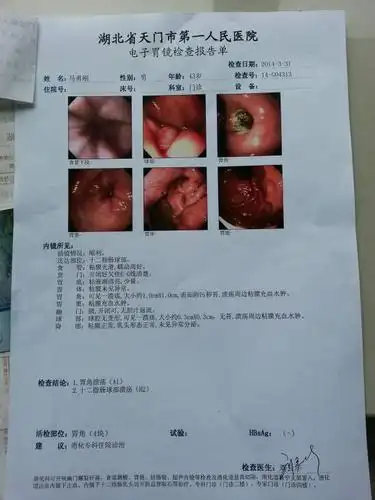 胃溃疡疼痛引起脖子左边上的胸锁乳突肌疼,还压迫声带,请问医生这是