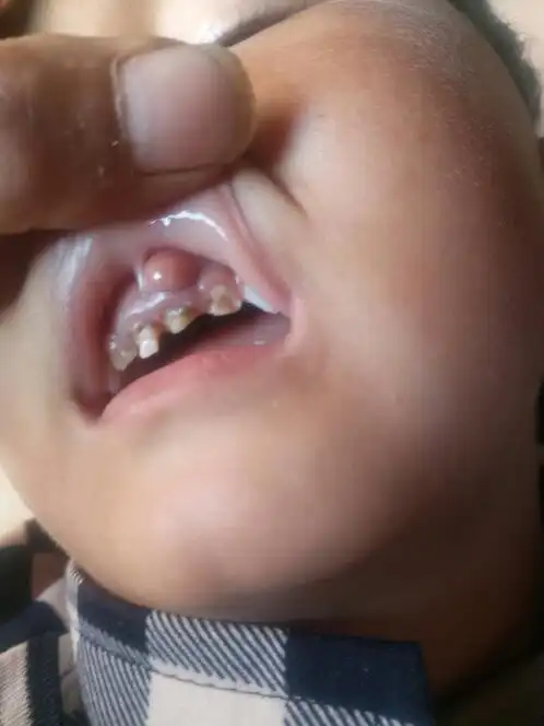 3岁小孩牙齿旁边有个肉包