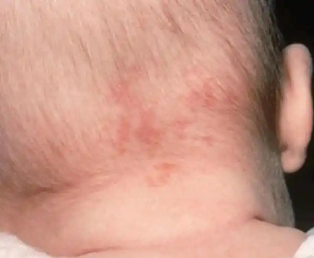 盘点多发于新生儿的7种胎记,有4种要特别注意!