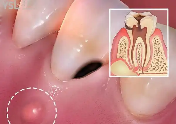 牙根尖炎如何快速消炎?这几个方法你一定要知道