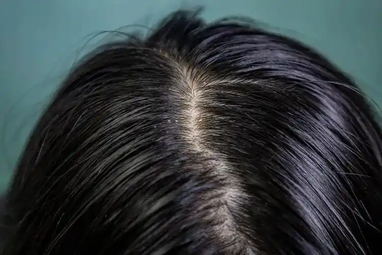 头发扁塌紧贴头皮,发缝线特别明显▼