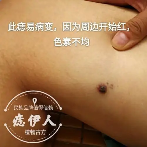 黑痣癌变,从发病到去世不到两个月!身上有这种痣要小心了