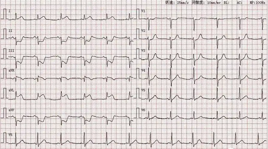 心电图图库丨心肌梗死系列