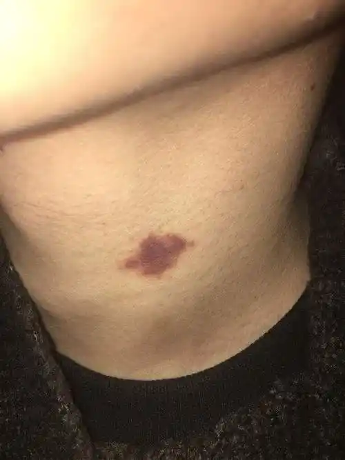 吴亦凡惊现"吻痕",如何从医学角度分辨是不是真的