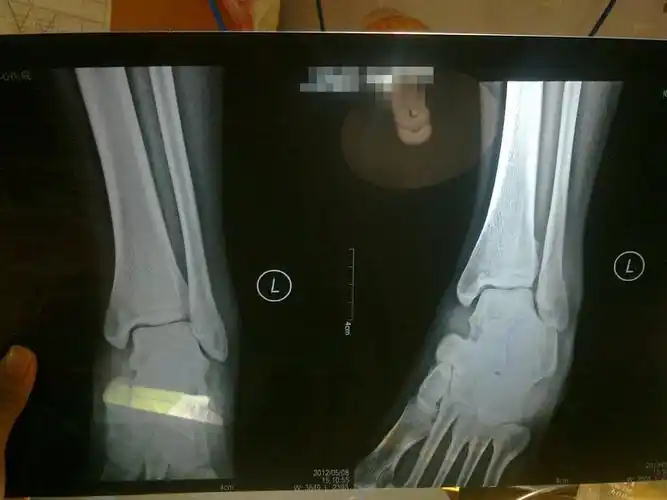 我的脚左外踝骨折,受伤了三周了,打石膏两周,请问,能拆石膏了吗?