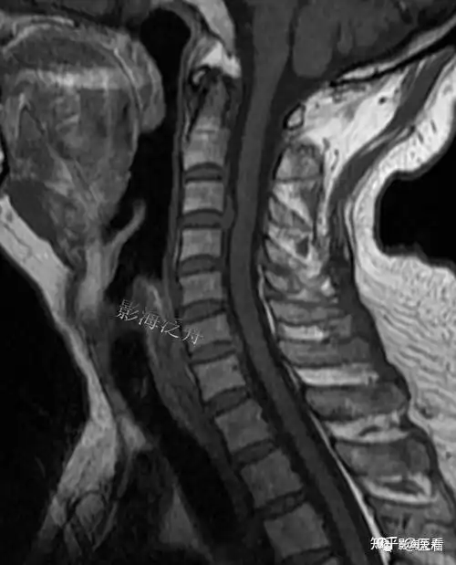 典型病例颈椎后纵韧带钙化mr
