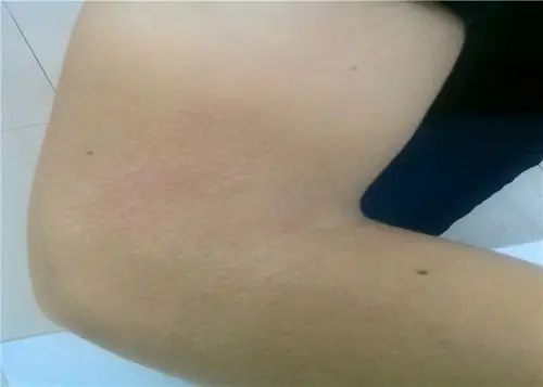 花斑癣头部脱毛症状图片