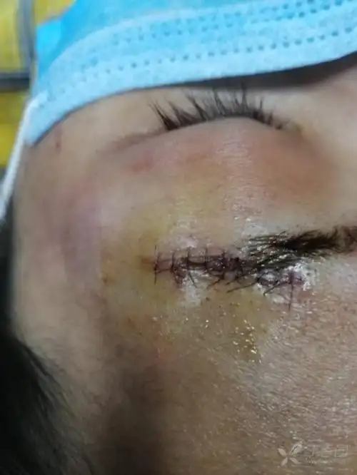 眉弓处缝美容线8针,受伤一小时后就赶往医院进行美容针缝合.
