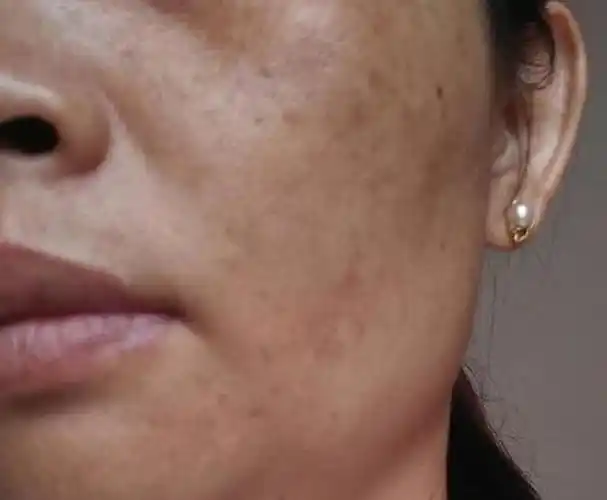 脸上有"黄褐斑"是无法避免的,如何淡化不反弹呢?