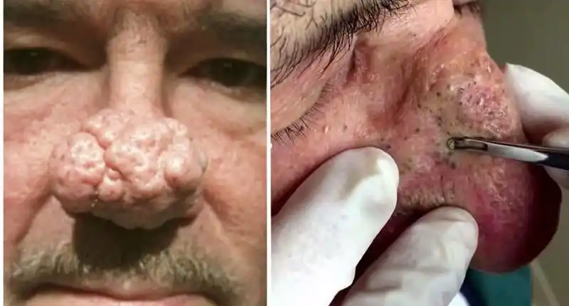 太恶心了!一口气挤掉鼻子上数之不尽的「黑头粉刺」居然是这种感觉.