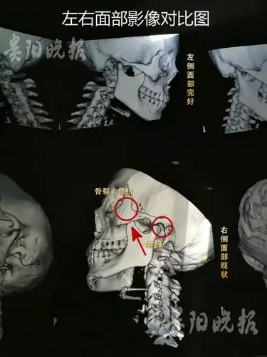 贵阳女子租摩拜单车刹车失灵撞到路边致颧骨骨折错位