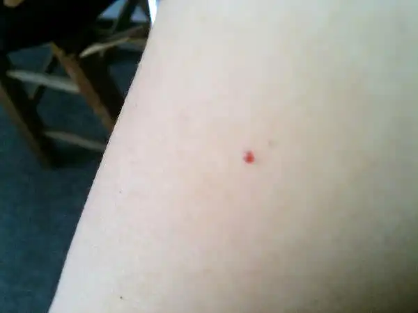 正常红痣的图片区别(带你全面认识普通红痣)-第2张图片-创女网