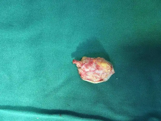 一例皮肤恶性肿瘤,左手虎口处肿物渐进性增大伴反复溃烂3年,入院初步