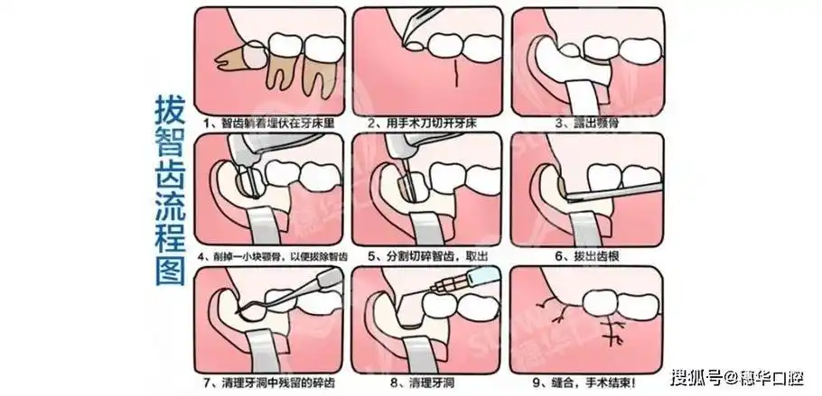 关于拔智齿,你还需要知道这些_医生_牙齿_牙龈