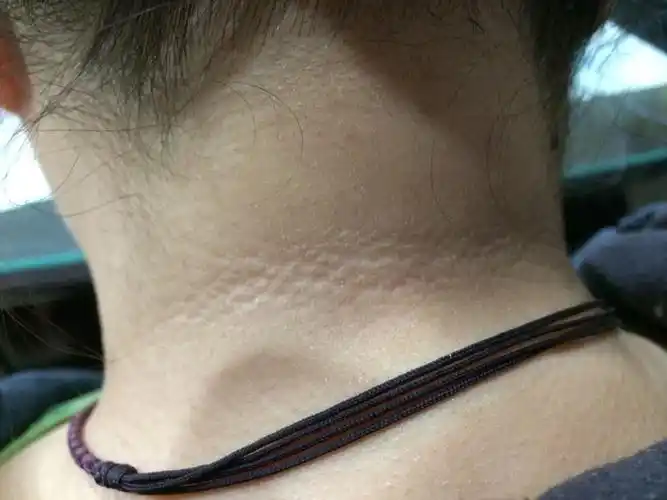 颈后黑一片洗澡搓不掉 竟是糖尿病前期「黑色棘皮症」