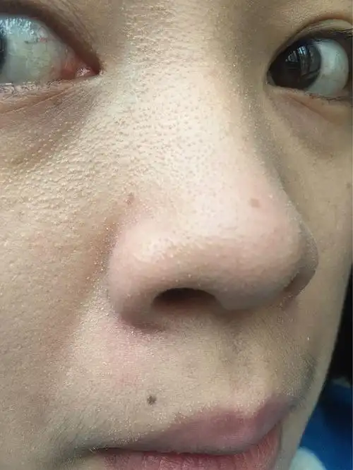 我这样满脸的脂肪粒还有救吗 有图