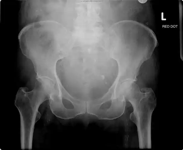 骨盆及髋关节的影像怎么看本文告诉你