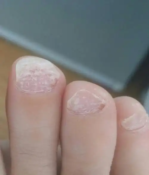 脚趾甲变白,不痛不痒,如图,不知有无大神给诊断一下,什么病症,怎么治