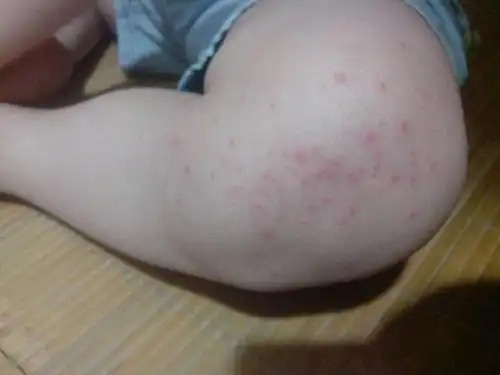 两边膝盖长满了这红色点点什么原因形成的呢?