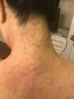 安顺普定县神经性皮炎能治好吗安顺普定县寻常型银屑病