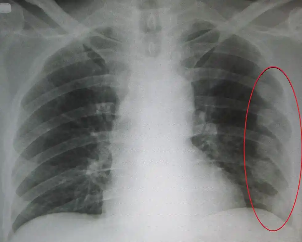 甘宁肋骨骨折,情况危险吗?